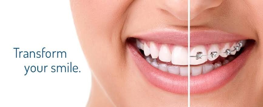 Best Dentist in Vizag  Invisalign Treatment in Vizag  Dental Implant